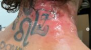pat-downey-reveals-graphic-photos-of-flesh-eating-disease-other-jpg