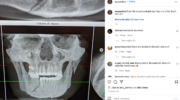 alex-polizzi-shows-x-ray-of-apparently-broken-jaw-from-brutal-png
