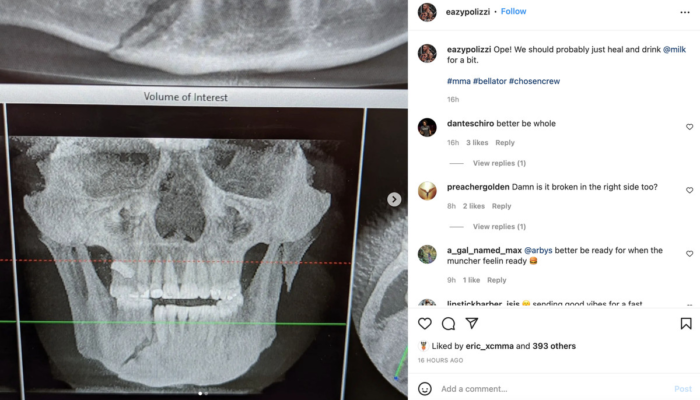 alex-polizzi-shows-x-ray-of-apparently-broken-jaw-from-brutal-png