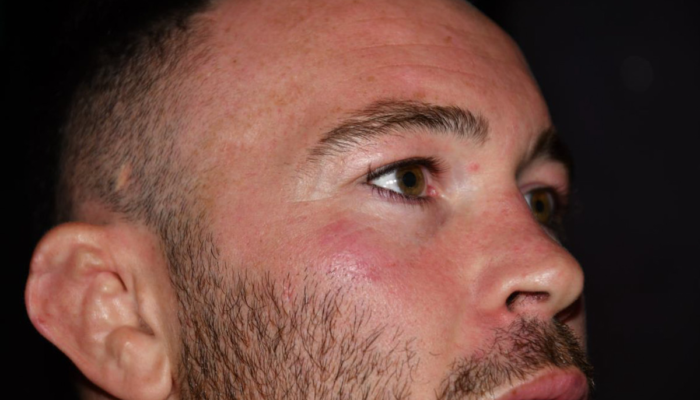 Pictures of Colby Covington after Jorge Masvidal’s alleged assault