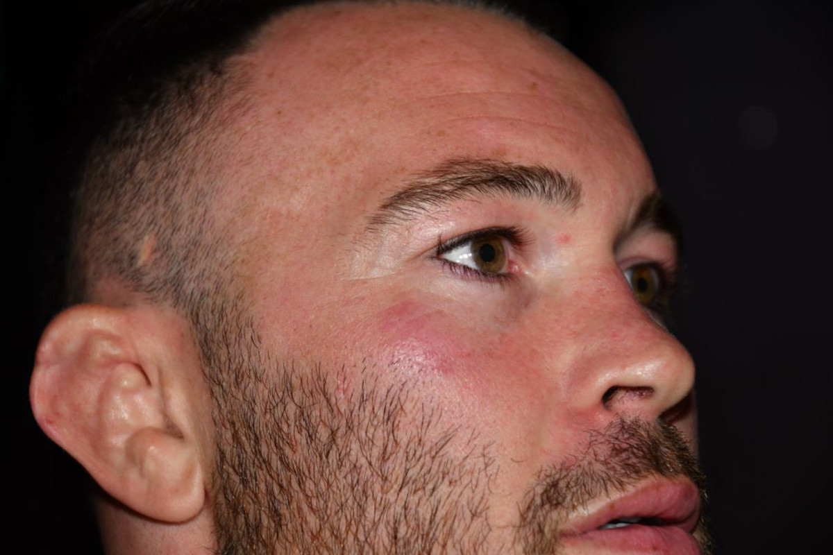 Pictures of Colby Covington after Jorge Masvidal’s alleged assault