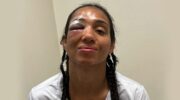 Taila Santos drabbades av en fraktur i ögonbanan i ett slagsmål med Valentina Shevchenko