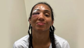 Taila Santos drabbades av en fraktur i ögonbanan i ett slagsmål med Valentina Shevchenko