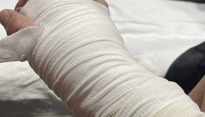 anthony-pettis-says-he-suffered-two-broken-hands-in-loss-png