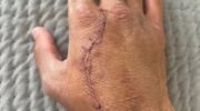 ward-holmatov-eliminator-laras-opponent-cordina-showed-his-hand-after-surgery-jpg